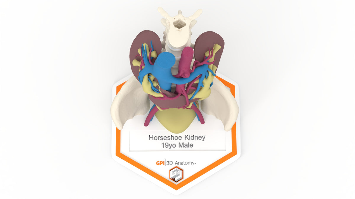 Horseshoe Kidney 19M