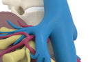 Horseshoe Kidney 19M