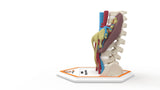 Horseshoe Kidney 7M