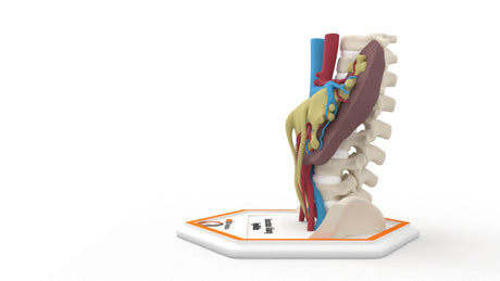 Horseshoe Kidney 7M