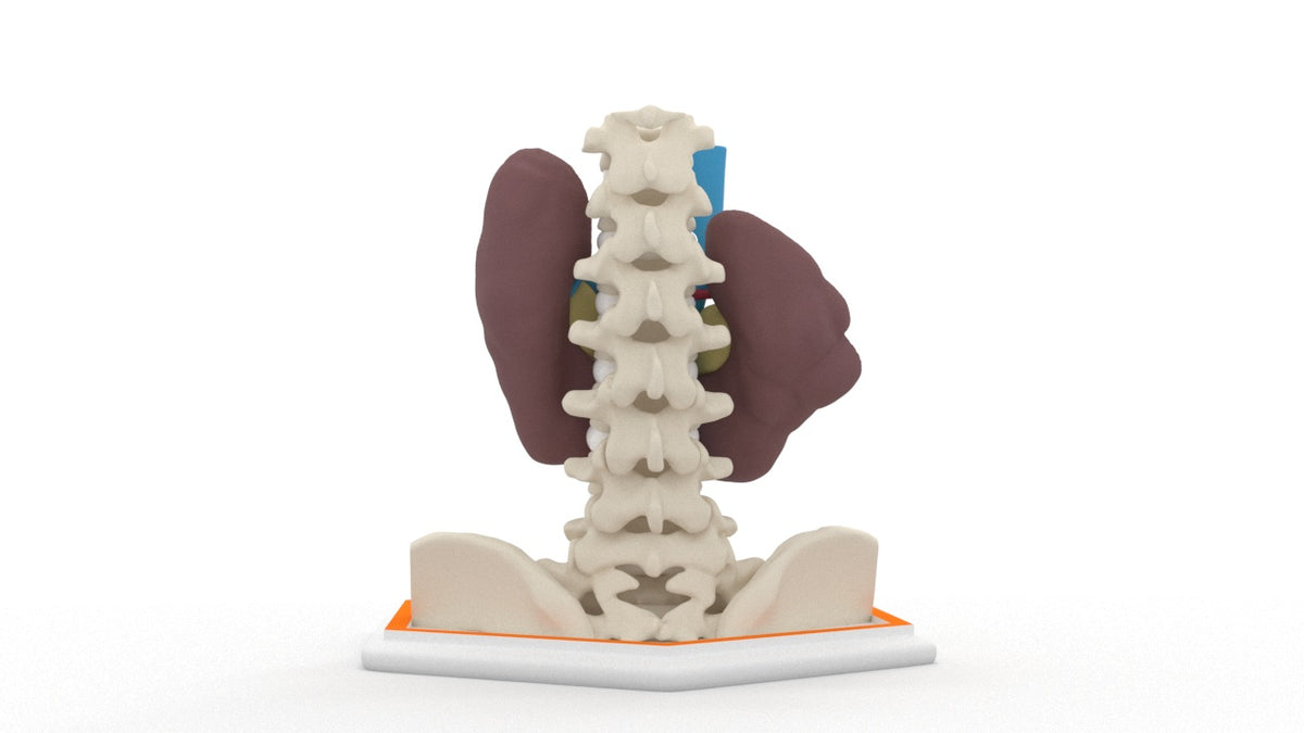 Horseshoe Kidney 7M