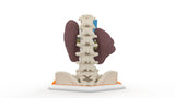 Horseshoe Kidney 7M