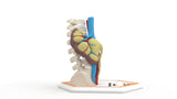 Horseshoe Kidney 7M
