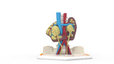 Horseshoe Kidney 7M