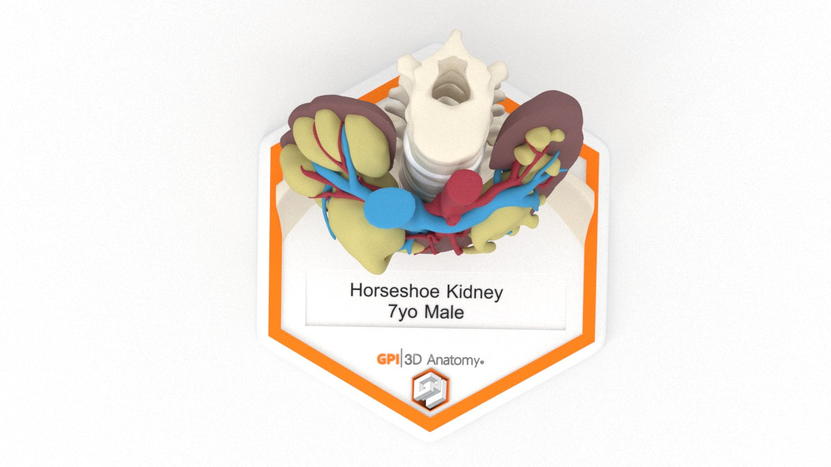 Horseshoe Kidney 7M