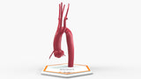 Kommerell's Diverticulum (More Round)
