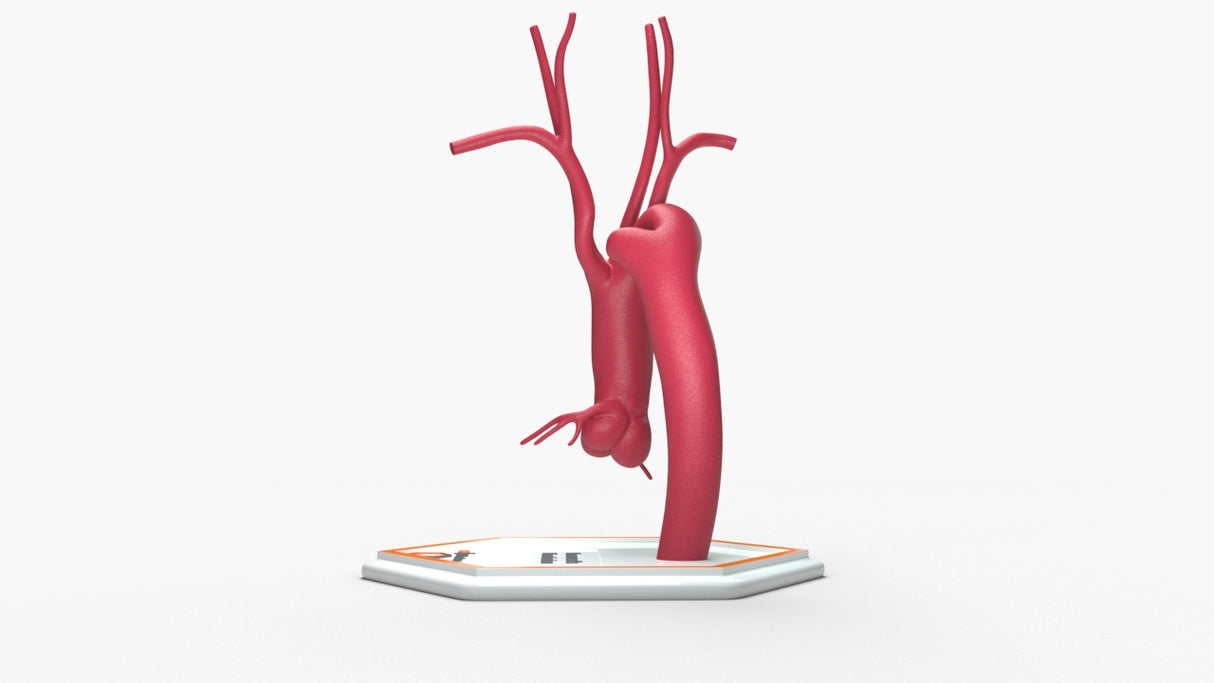 Kommerell's Diverticulum (More Round)