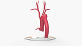 Kommerell's Diverticulum (More Round)