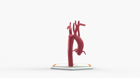 Kommerell's Diverticulum (Connected)