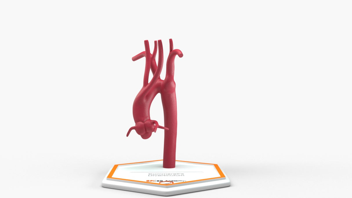 Kommerell's Diverticulum (Connected)