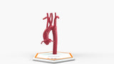 Kommerell's Diverticulum (Connected)