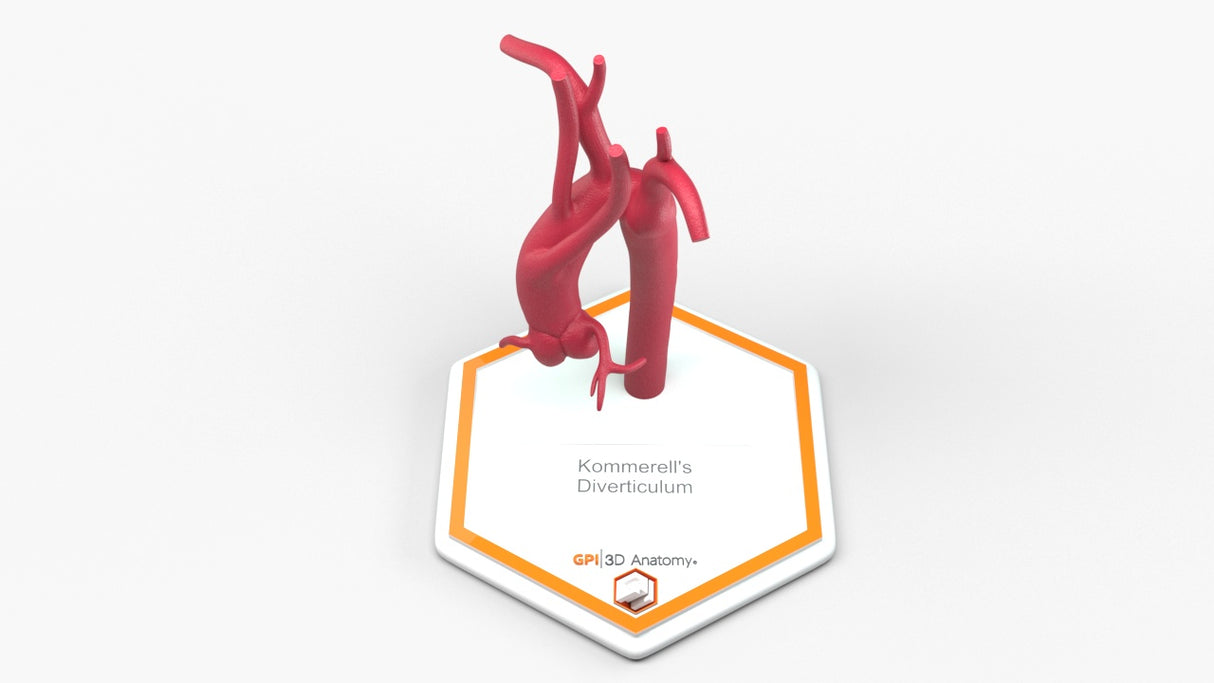 Kommerell's Diverticulum (Connected)