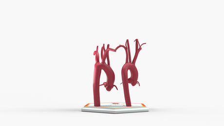 Normal & Kommerell's Diverticulum (Connected)