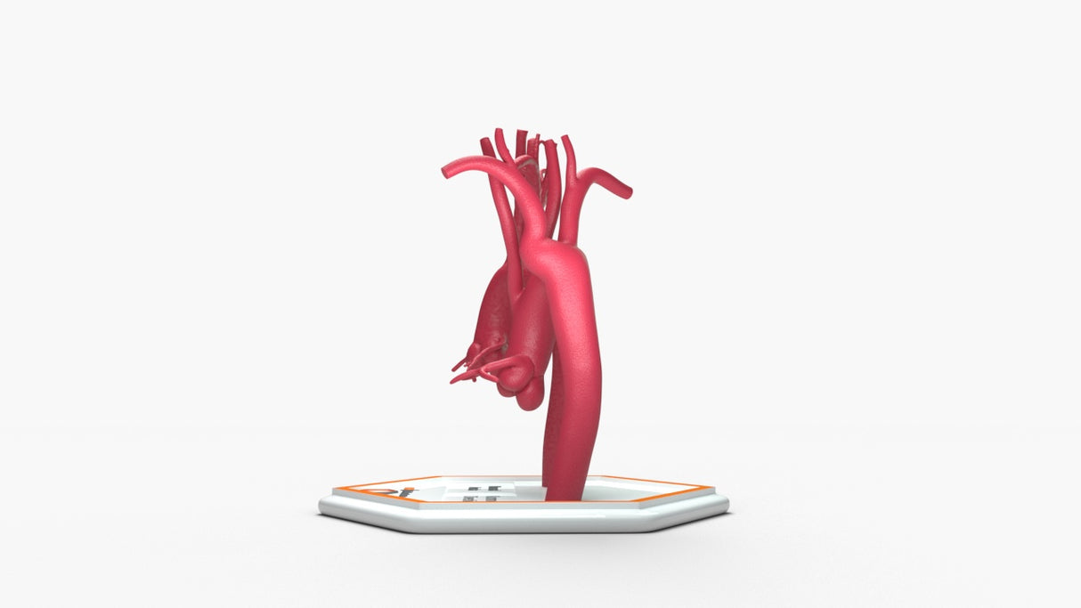 Normal & Kommerell's Diverticulum (Connected)