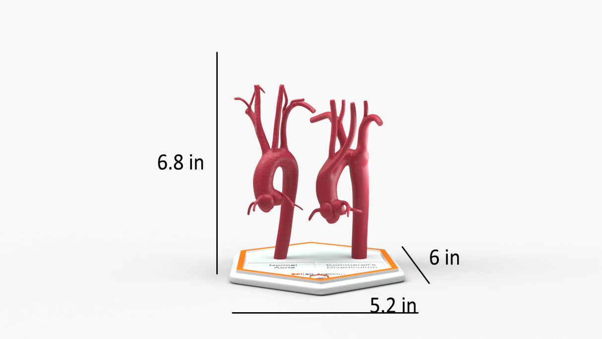 Normal & Kommerell's Diverticulum (Connected)