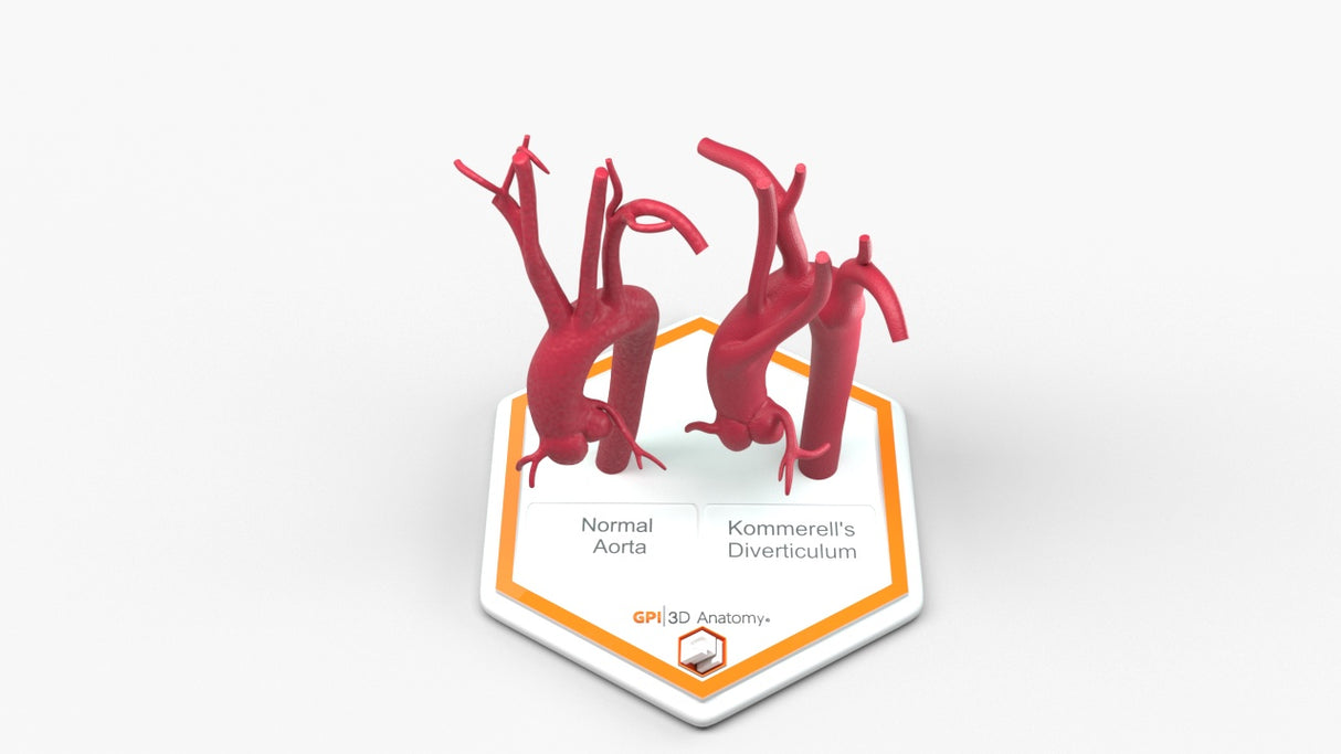 Normal & Kommerell's Diverticulum (Connected)