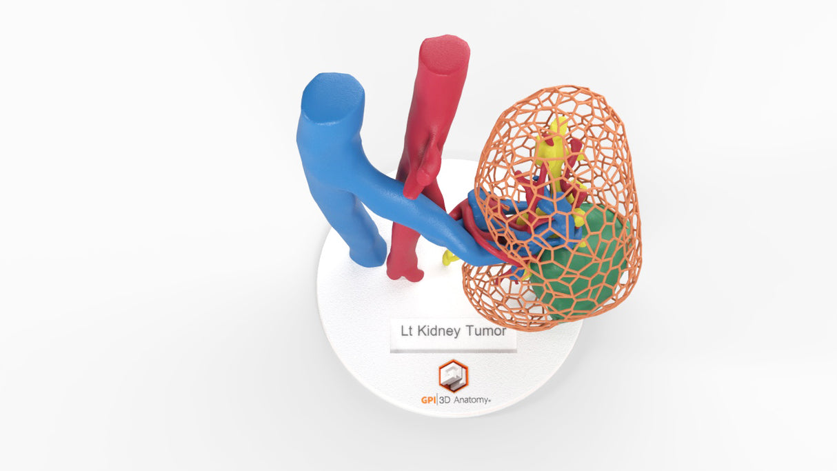 Lattice Left Kidney With Neoplasm - Male, 50 Years