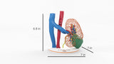Lattice Left Kidney With Neoplasm - Male, 50 Years