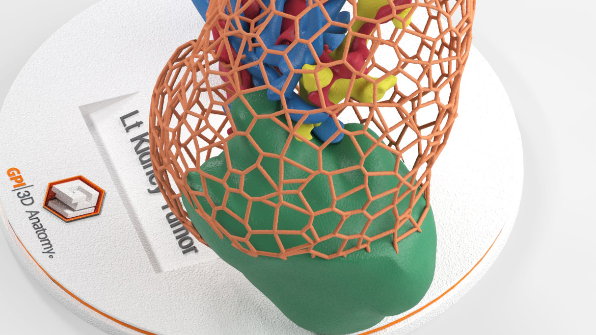 Lattice Left Kidney With Neoplasm - Male, 50 Years