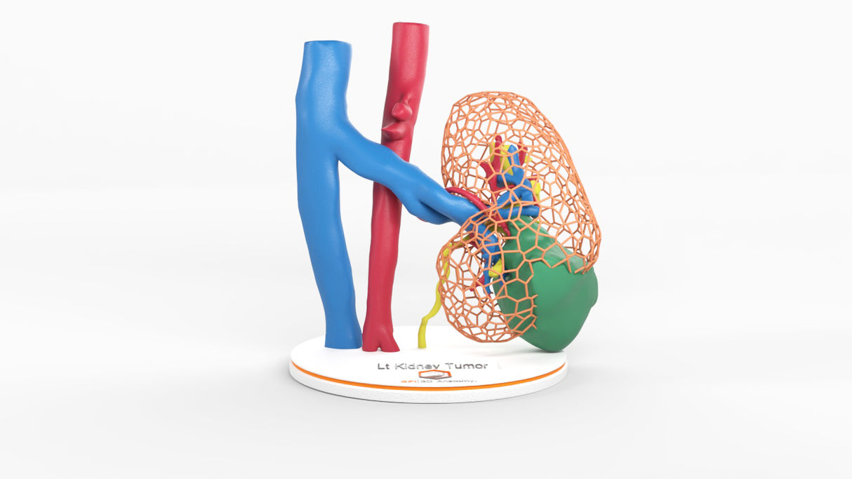 Lattice Left Kidney With Neoplasm - Male, 50 Years