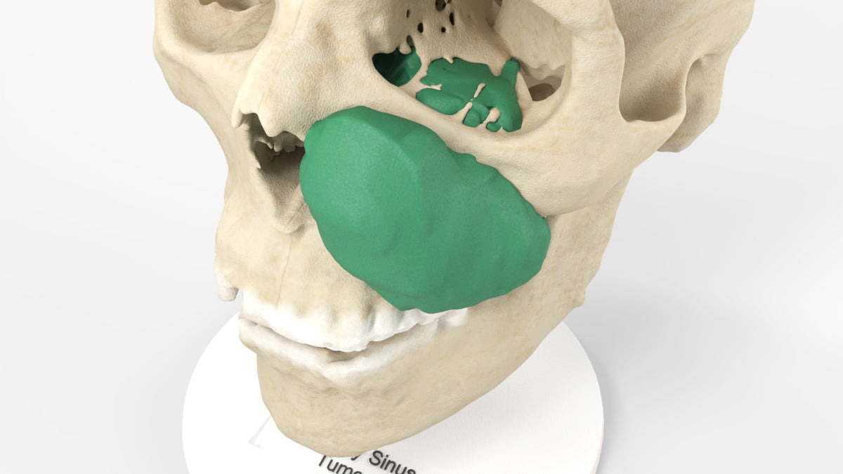 Sinuscam Custom 3D Anatomy Models | Maxillary Sinus Tumor Model | Squamous Cell ...