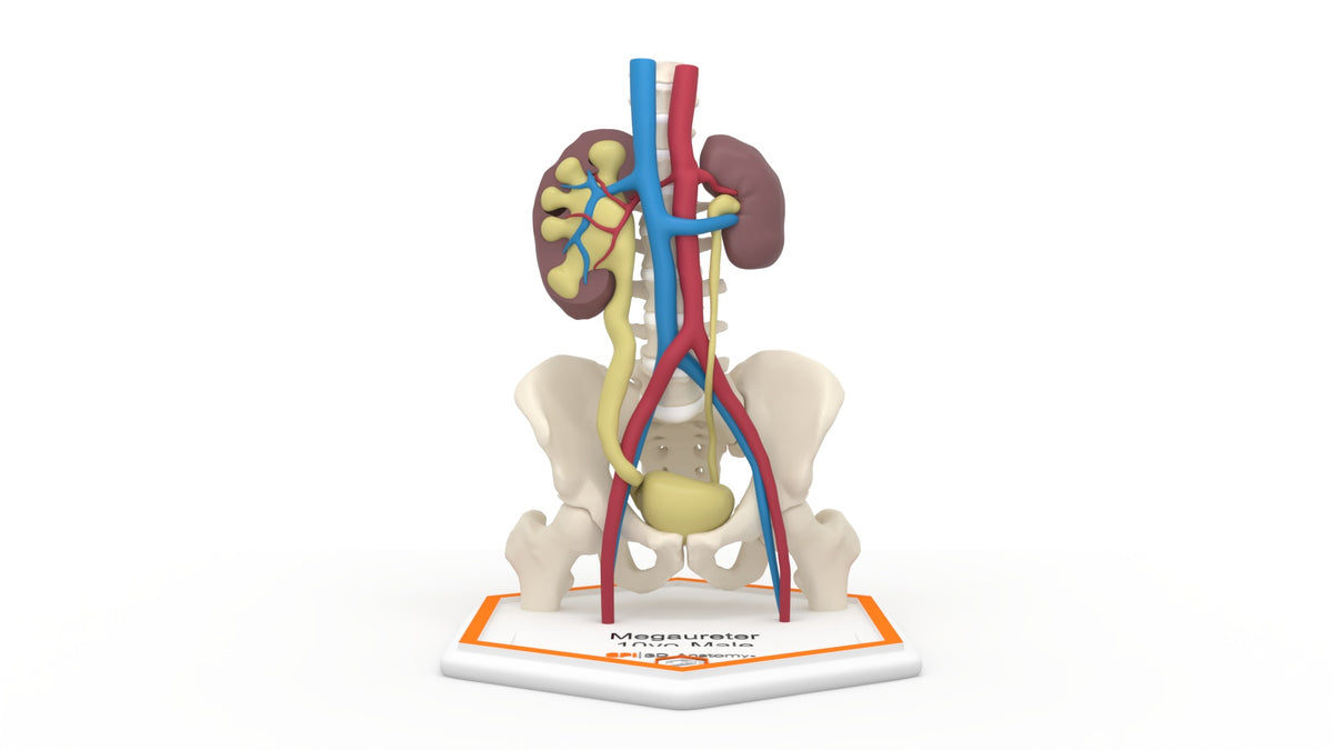 Mega Ureter 10 M