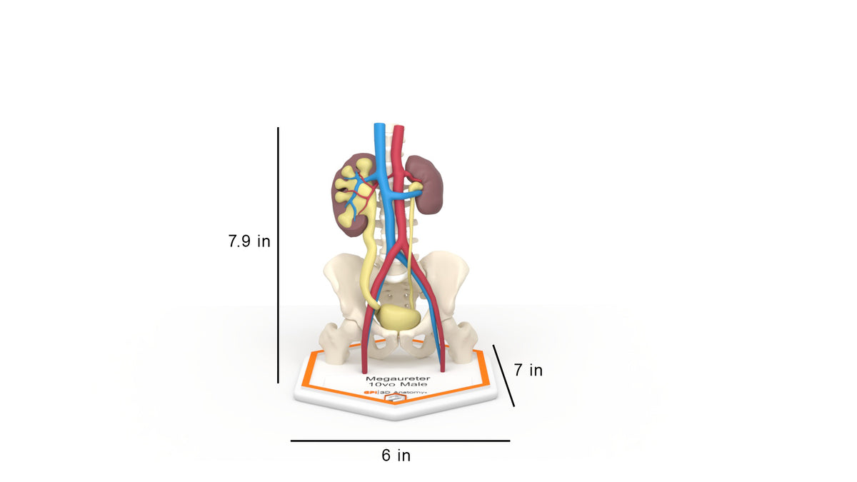 Mega Ureter 10 M