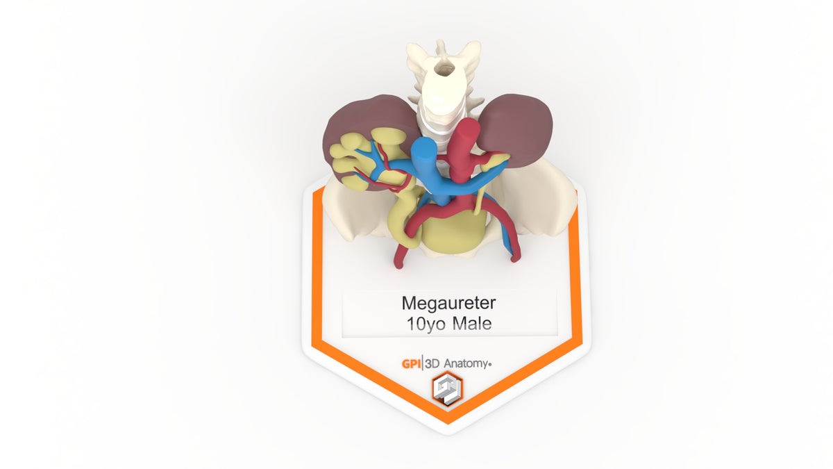 Mega Ureter 10 M