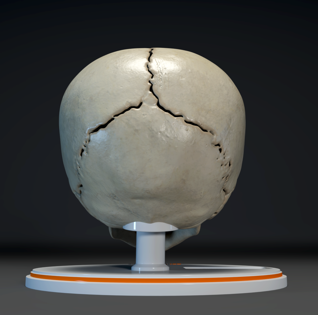 Metopic Ridge Fracture Custom 3D Anatomy Models | Craniosynostosis | Metopic Suture ...