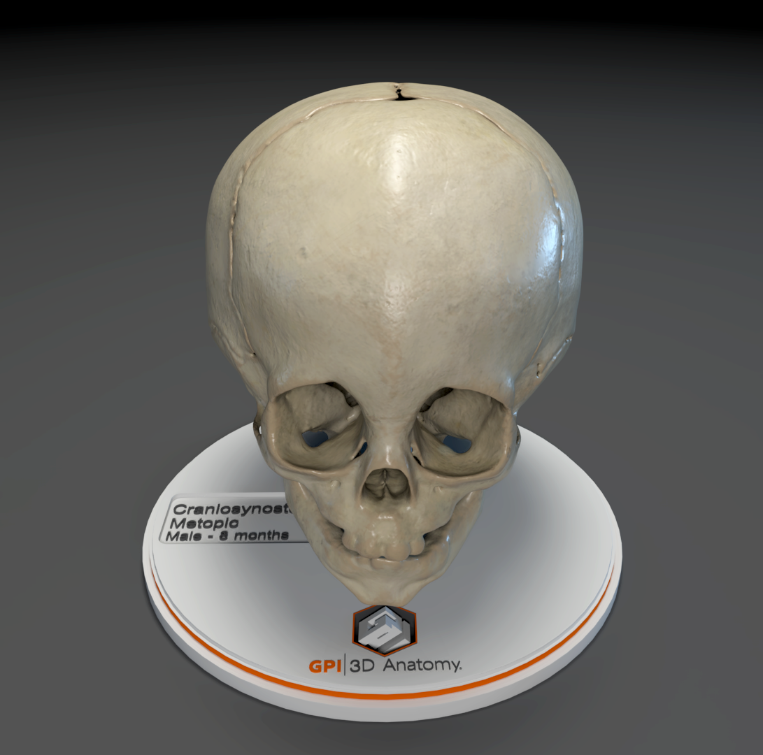 Custom 3D Anatomy Models | Craniosynostosis | Metopic Suture ...