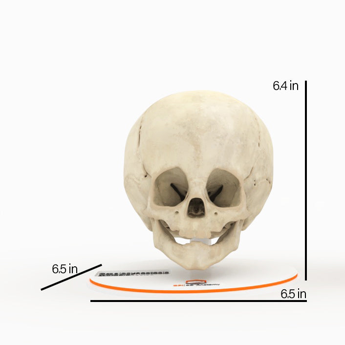 Infant Skull With Craniosynostosis of the Metopic Suture - Male, 8 Months