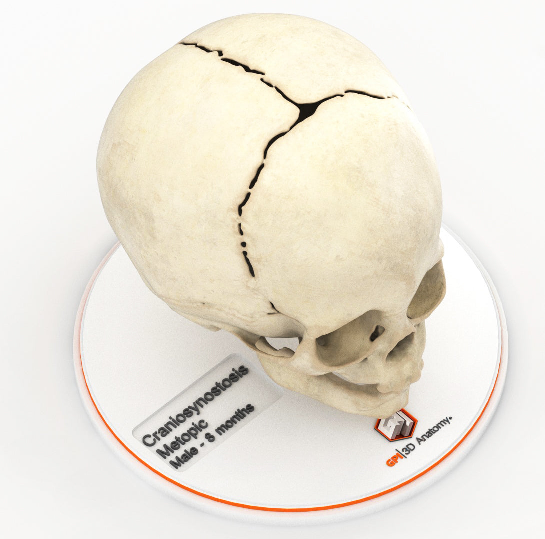 Metopic Ridge Fracture Custom 3D Anatomy Models | Craniosynostosis | Metopic Suture ...