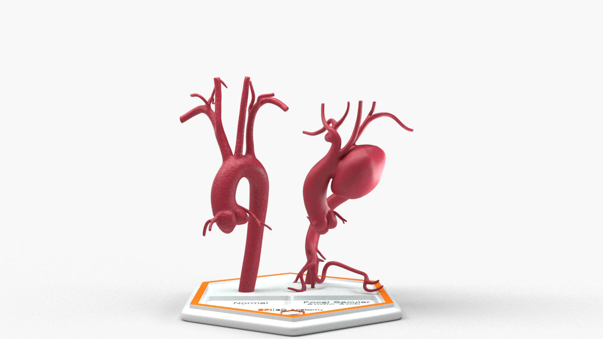 Aortic Arch - Normal and Focal Sacular Aneurysm