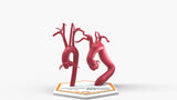 Aortic Arch - Normal and Fusiform with Proximal Descending Aneurysm