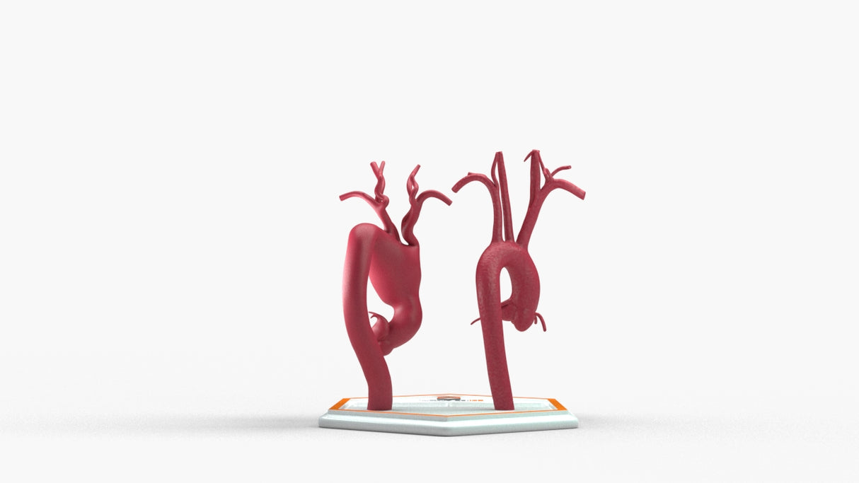 Aortic Arch - Normal and Fusiform Aneurysm