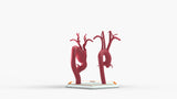 Aortic Arch - Normal and Fusiform Aneurysm