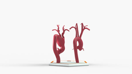 Aortic Arch - Normal and Fusiform Aneurysm