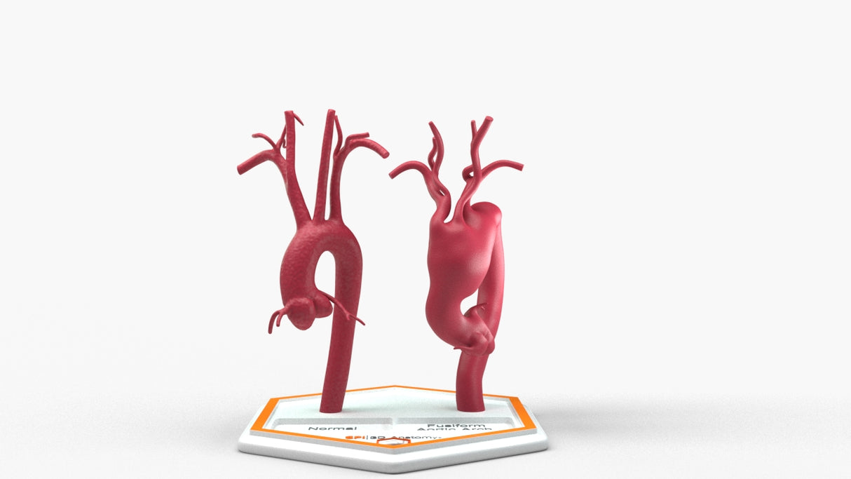 Aortic Arch - Normal and Fusiform Aneurysm