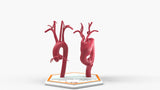 Aortic Arch - Normal and Fusiform Aneurysm
