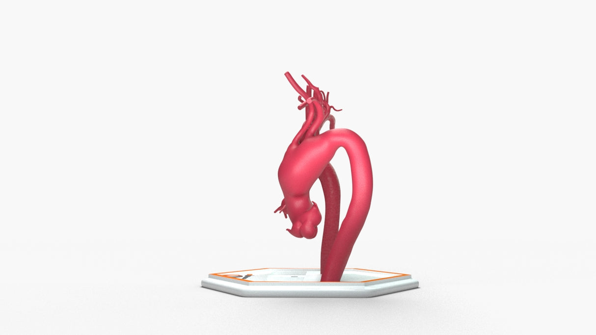 Aortic Arch - Normal and Fusiform Aneurysm