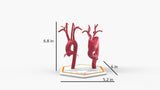 Aortic Arch - Normal and Fusiform Aneurysm