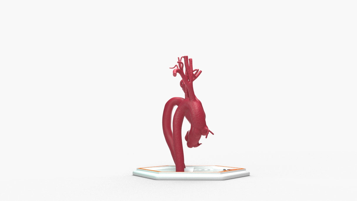 Aortic Arch - Normal and Fusiform Aneurysm