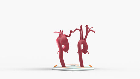 Aortic Arch - Normal & Fusiform Ascending Aneurysm