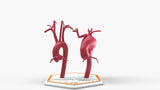 Aortic Arch - Normal and Fusiform Aneurysm