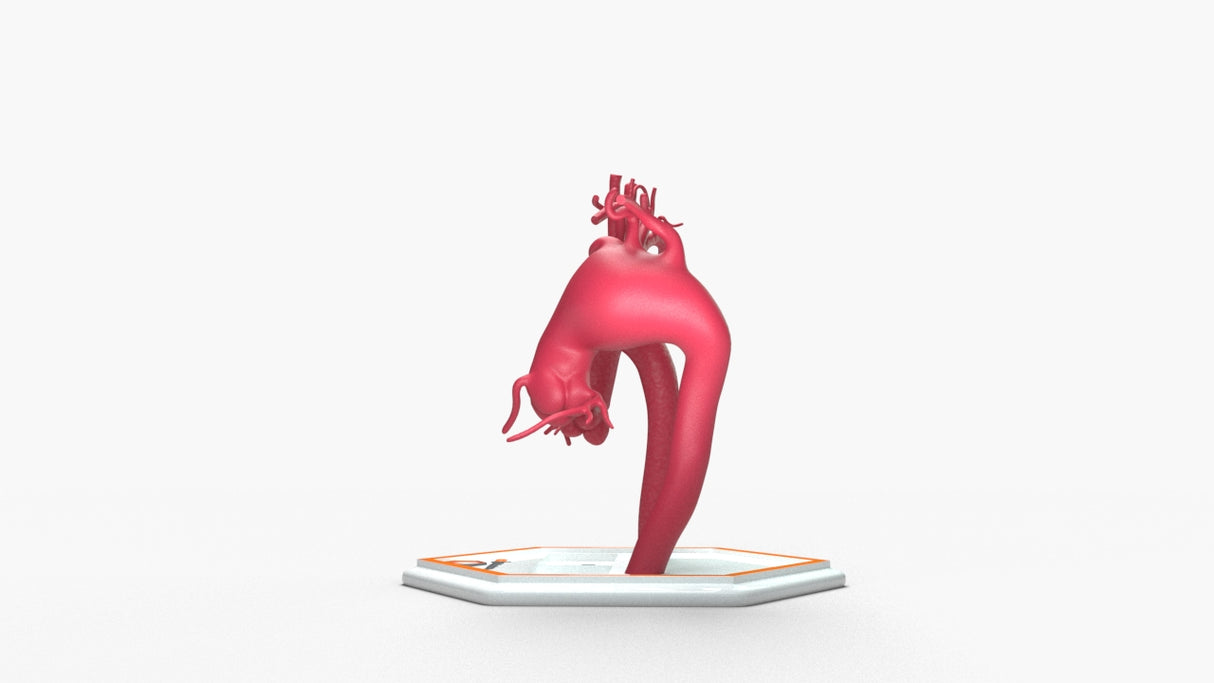 Aortic Arch - Normal & Fusiform Ascending Aneurysm