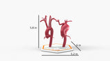 Aortic Arch - Normal & Fusiform Ascending Aneurysm