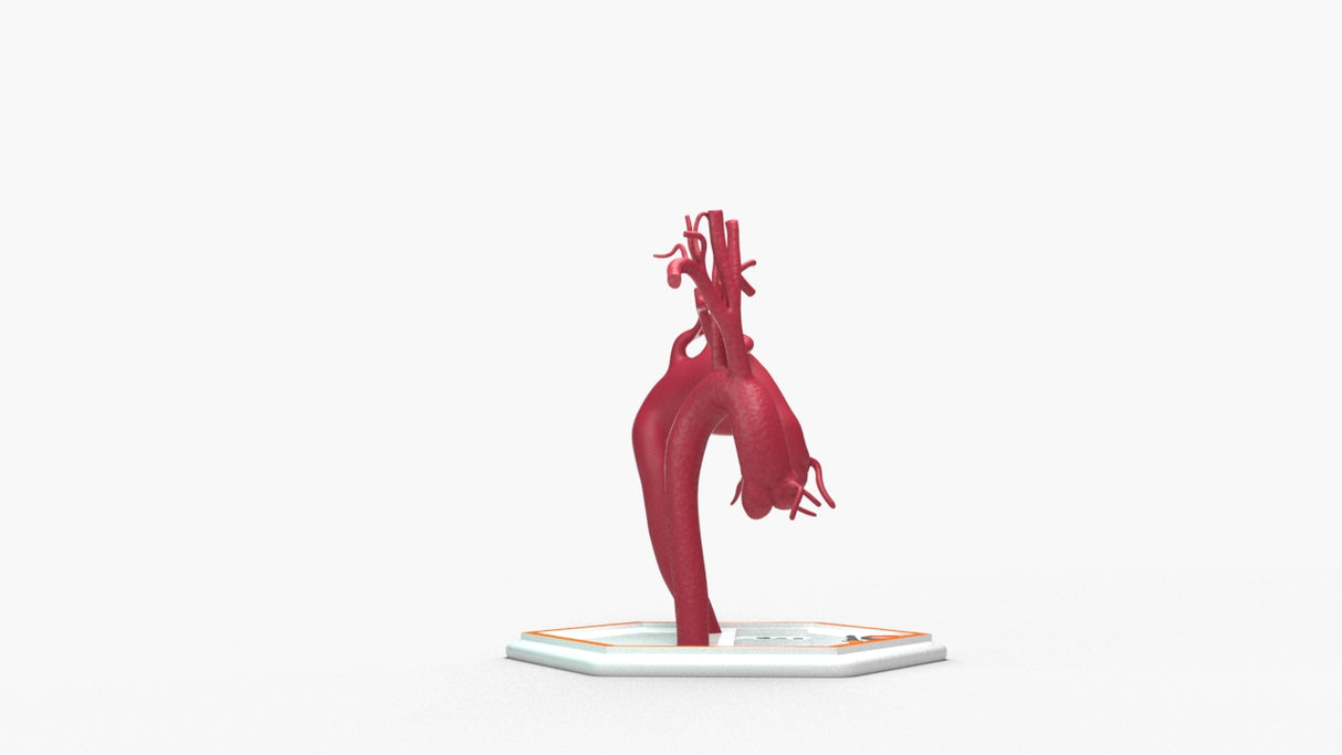 Aortic Arch - Normal & Fusiform Ascending Aneurysm
