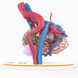 Lattice Pelvic Kidney With Neoplasm and Cysts - Male, 78 Years