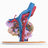 Lattice Pelvic Kidney With Neoplasm and Cysts - Male, 78 Years