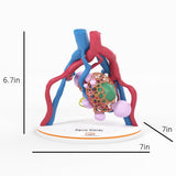 Lattice Pelvic Kidney With Neoplasm and Cysts - Male, 78 Years